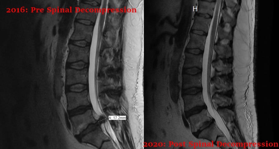 Herniated Disc, Bangor, Ellsworth